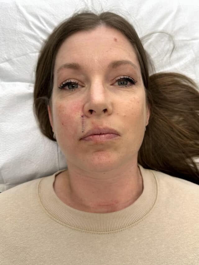 Woman after MOHS surgery with eight stitches.