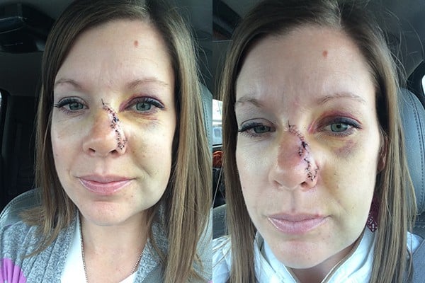 Two side-by-side pictures of a woman with a bruised and stitched up nose.