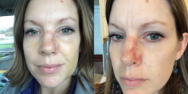 Two side-by-side pictures of a woman with a large scar on her nose. 