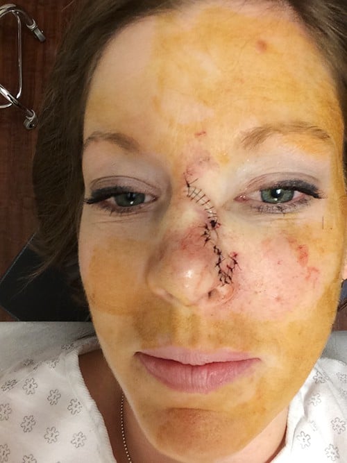 A woman's face who just had surgery on her nose.