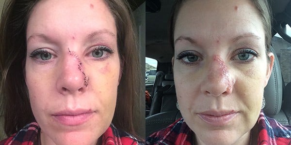 Two side-by-side pictures of a woman with stitches on her nose. 